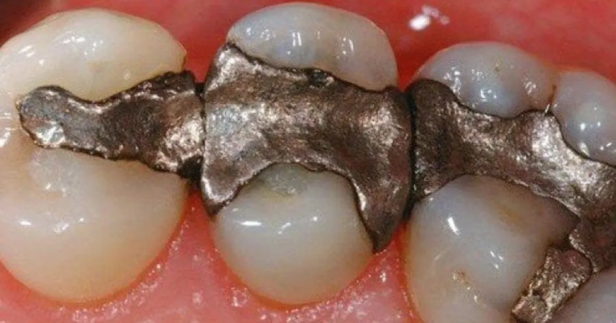 Amalgam Filling Removal Why It's Critical to Your Health Amalgam Filling Removal Why It's Critical to Your Health