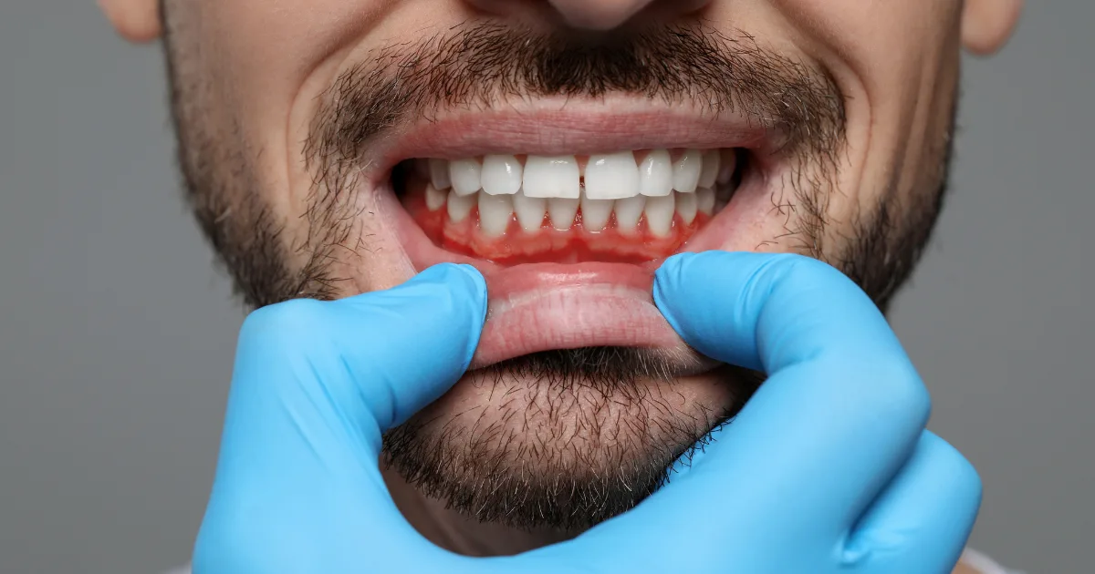 Guide to Gum Disease Treatments Guide to Gum Disease Treatments
