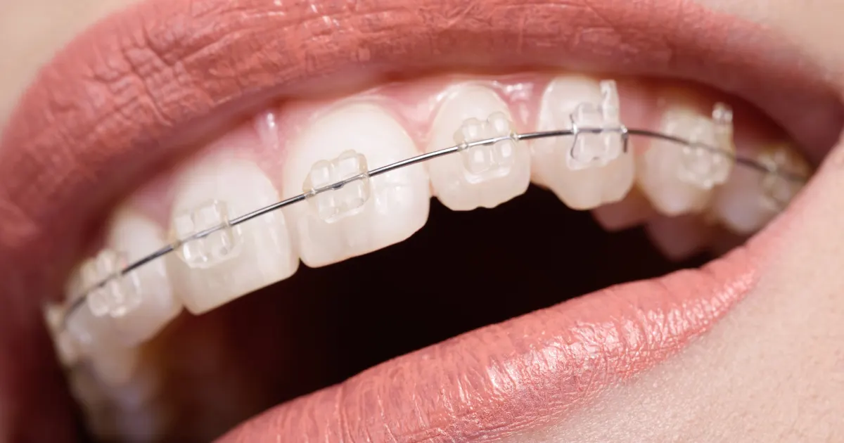 Alternatives to Braces for Teens Alternatives to Braces for Teens
