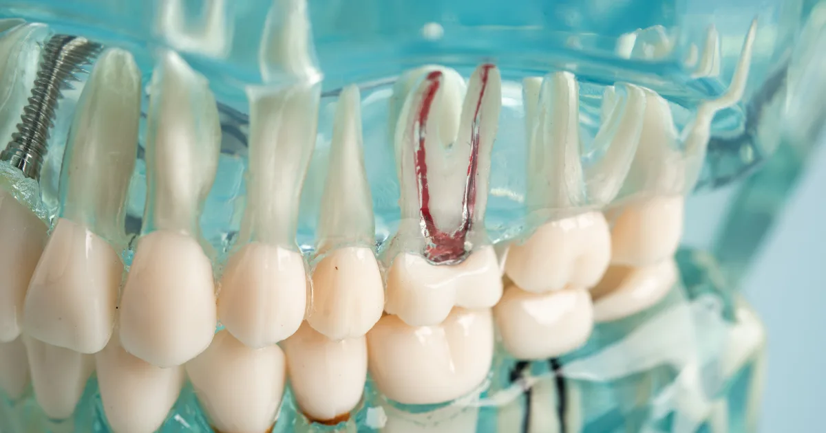 Why Do I Need a Root Canal (1) Why Do I Need a Root Canal (1)