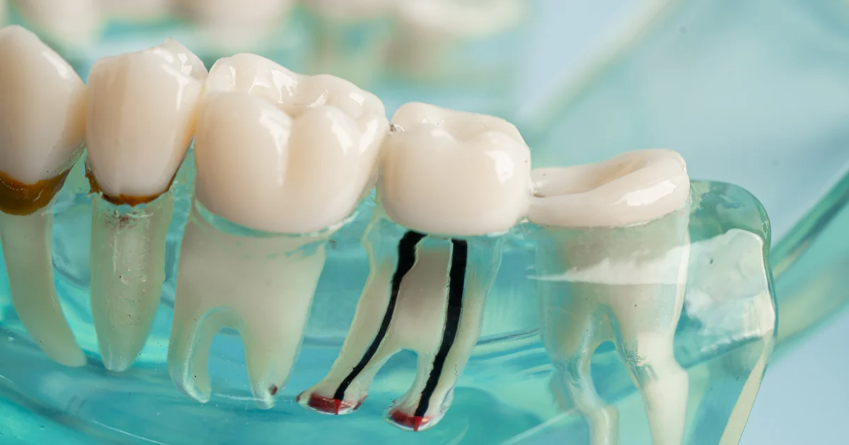 5 Qualities for Philadelphia Root Canal Dentists 5 Qualities for Philadelphia Root Canal Dentists